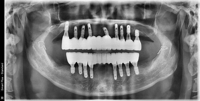 Yaksu Station Dental Clinic: How Many Implants Are Needed for Full Mouth Implants?