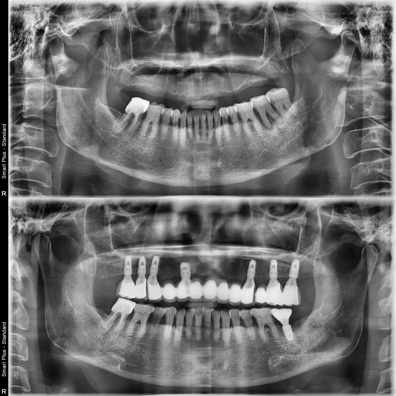 Yaksu Station Dental Clinic: How Many Implants Are Needed for Full Mouth Implants?