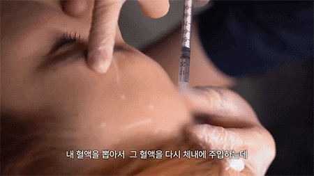 PRP와 MCT 자가엑소좀, 차이는 어디에 있을까요? 사진 5
