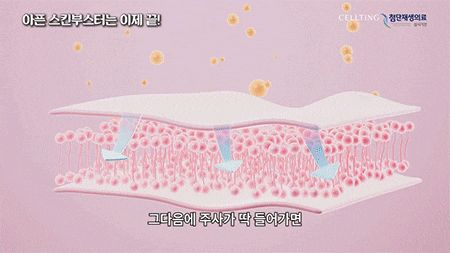 청담동피부과 스킨부스터 NP광채재생술 어떤 점이 다를까?