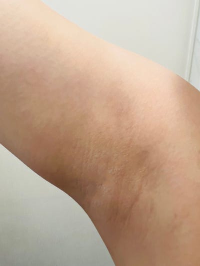 분당 부유방 병원 직원도 부유방 수술을 맡기는 병원 사진 2