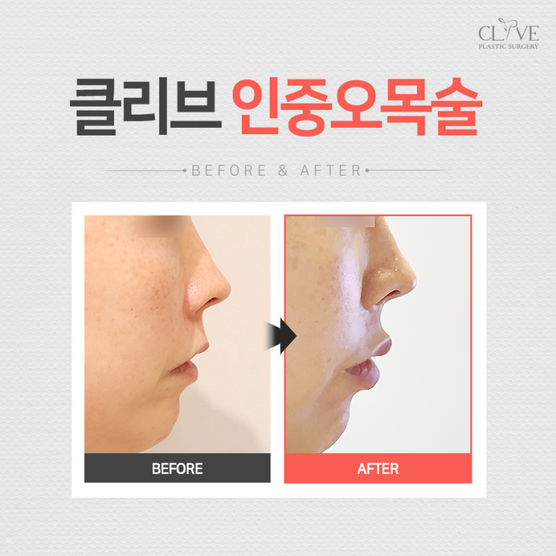 Sinsa Station Lip Filler + C-Curl Philtrum Dimple Creation at Clyve Event