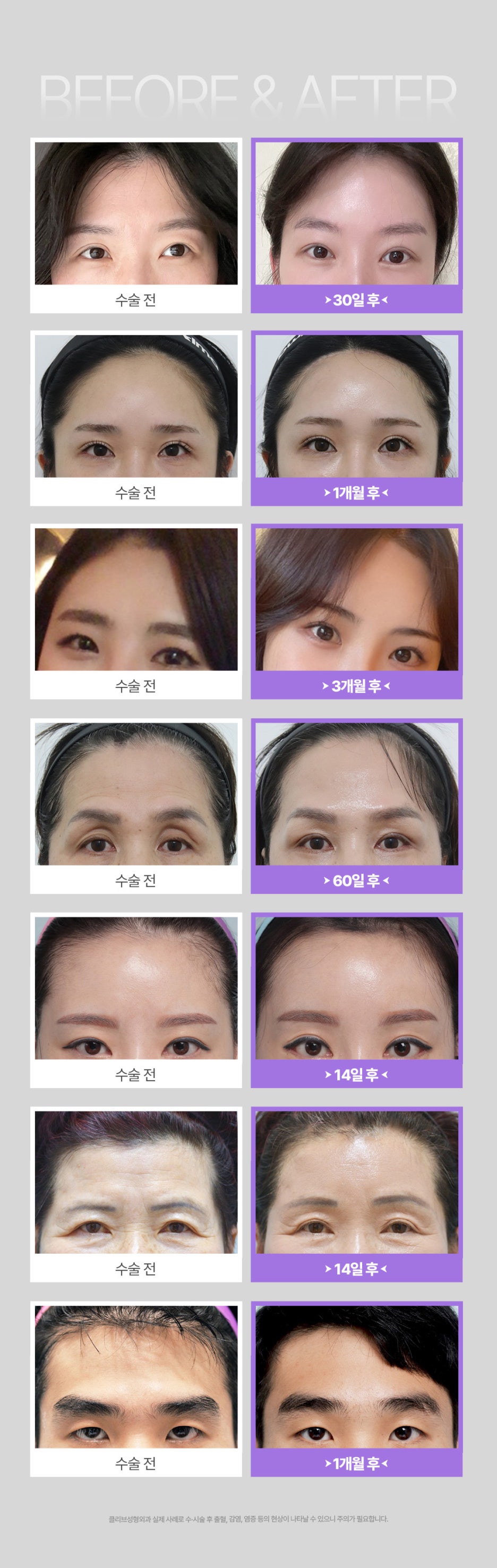 처진 피부와 주름을 개선하여 동안외모를 만드는 방법