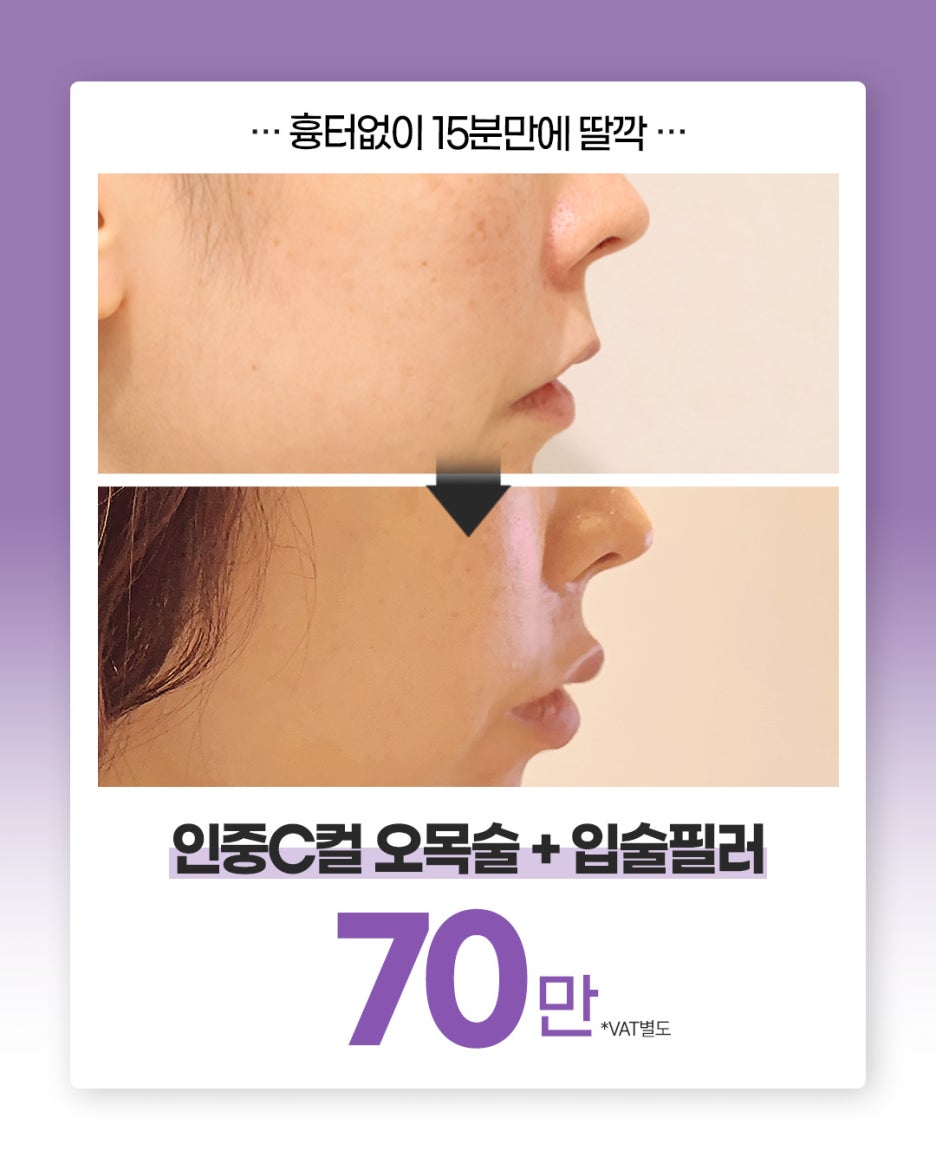 신사역입술필러로 만든 C컬라인 인중오목술