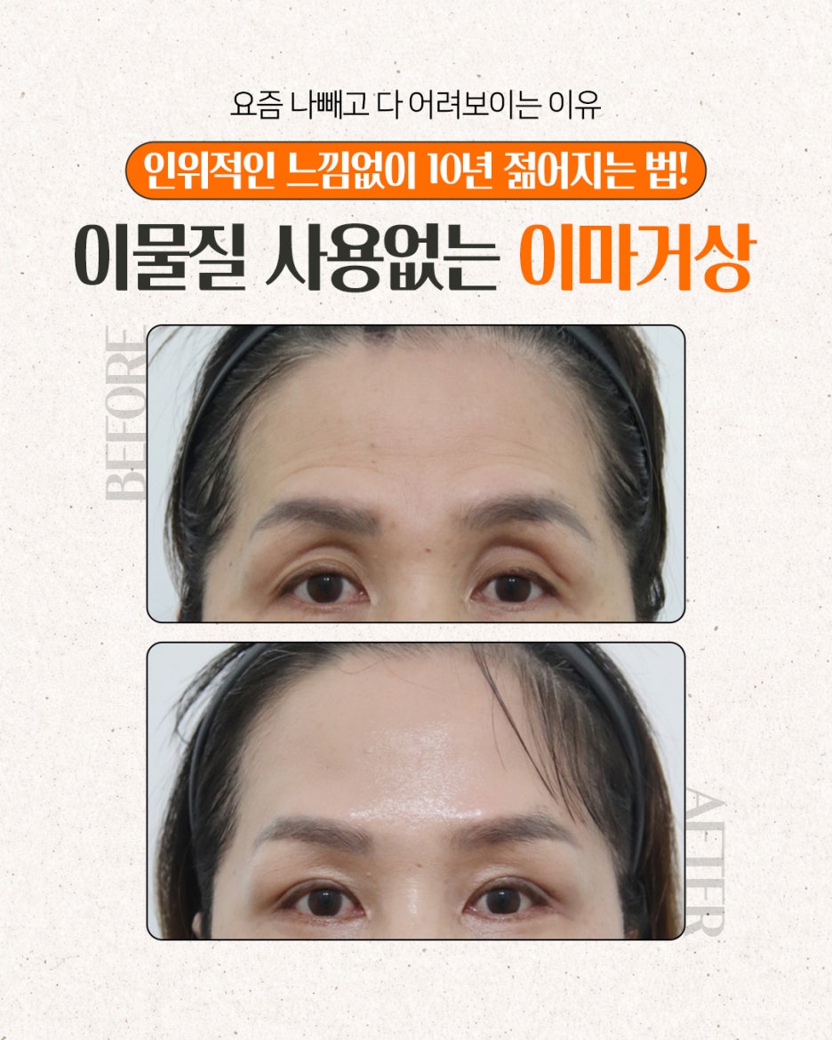 Memahami Pembengkakan, Bekas Luka, dan Memar Setelah Facelift di Seoul Sekaligus