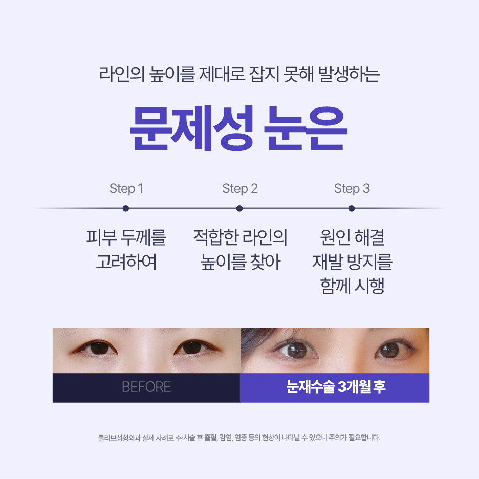 Nonhyeon Station Plastic Surgery: When and How to Get Eyelid Revision Surgery?
