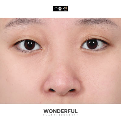 코안실밥Ⅰ눈코수술 5일차 리얼 후기 Ⅰ주차별 전후 비교 사진 8