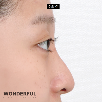 코안실밥Ⅰ눈코수술 5일차 리얼 후기 Ⅰ주차별 전후 비교 사진 10