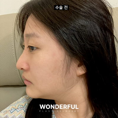 코안실밥Ⅰ눈코수술 5일차 리얼 후기 Ⅰ주차별 전후 비교 사진 2
