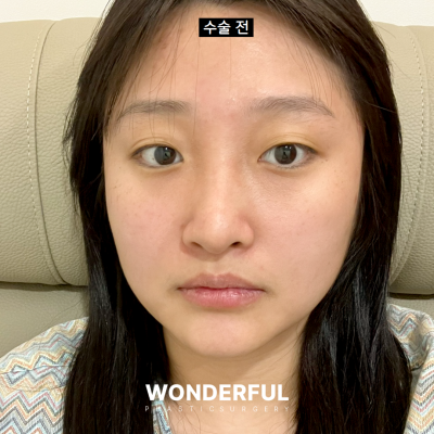 코안실밥Ⅰ눈코수술 5일차 리얼 후기 Ⅰ주차별 전후 비교