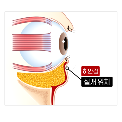 하안검 5060 보세요!Ⅰ젊어지는 눈밑수술 사진 6