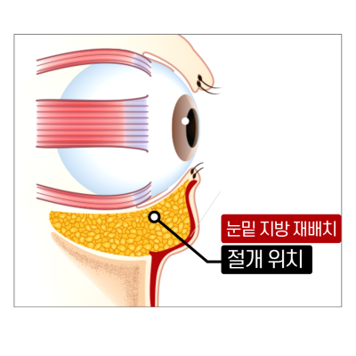 하안검 5060 보세요!Ⅰ젊어지는 눈밑수술 사진 5