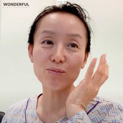 하안검 회복기간Ⅰ수술 전 후Ⅰ한달 차Ⅰ50대 리얼 후기 사진 2