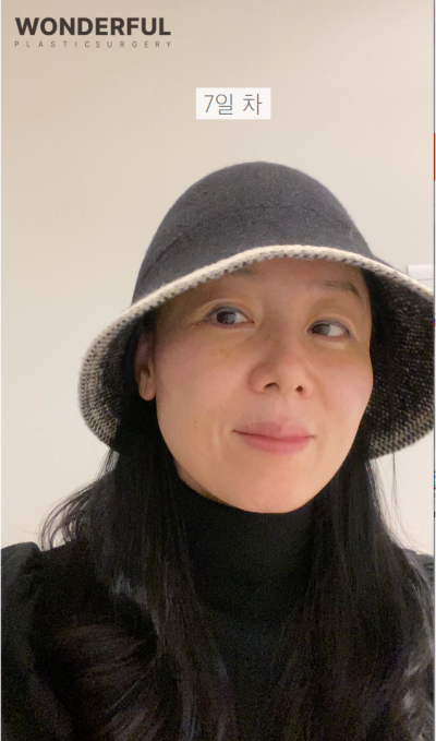 하안검 회복기간Ⅰ수술 전 후Ⅰ한달 차Ⅰ50대 리얼 후기 사진 5