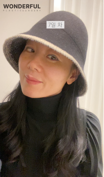 하안검 회복기간Ⅰ수술 전 후Ⅰ한달 차Ⅰ50대 리얼 후기 사진 8