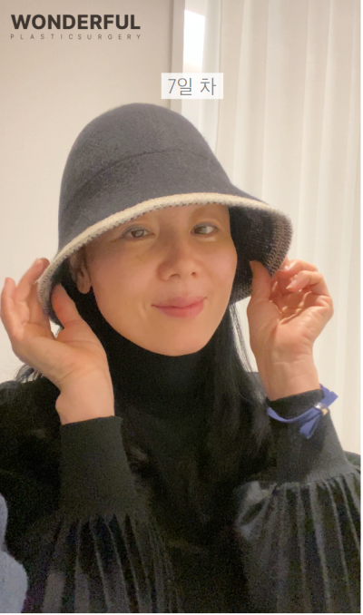 하안검 회복기간Ⅰ수술 전 후Ⅰ한달 차Ⅰ50대 리얼 후기 사진 7