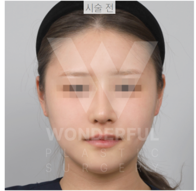 요즘 대세 요정 귀 " 진짜 효과 좋나요?" 귀 필러 직 후 비교 사진 4