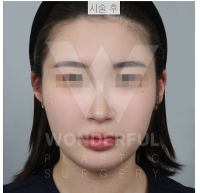 요즘 대세 요정 귀 " 진짜 효과 좋나요?" 귀 필러 직 후 비교
