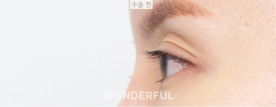 눈위꺼짐(아이홀)해결은 지방이식수술, 눈매교정까지가능 사진 6