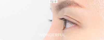눈위꺼짐(아이홀)해결은 지방이식수술, 눈매교정까지가능 사진 7