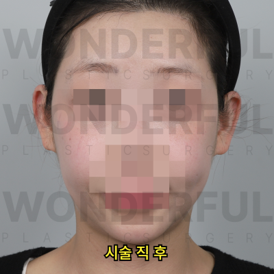 귀필러 시술효과, 교정 전후비교, 붓기,통증 정리 사진 13