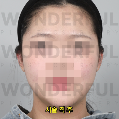귀필러 시술효과, 교정 전후비교, 붓기,통증 정리 사진 11