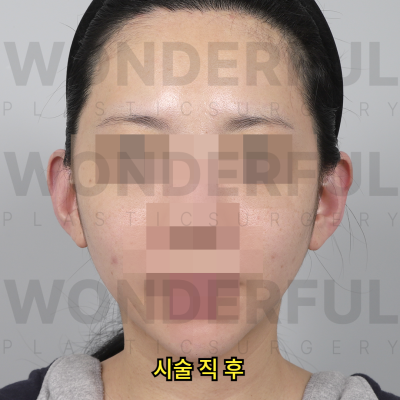 귀필러 시술효과, 교정 전후비교, 붓기,통증 정리 사진 7