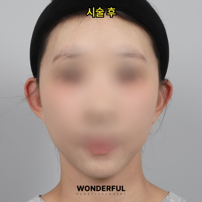 귀필러 효과 총정리! 중안부,광대,비대칭 비교 사진 3