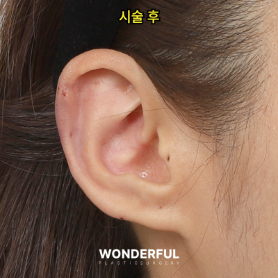 귀필러 효과 총정리! 중안부,광대,비대칭 비교 사진 15