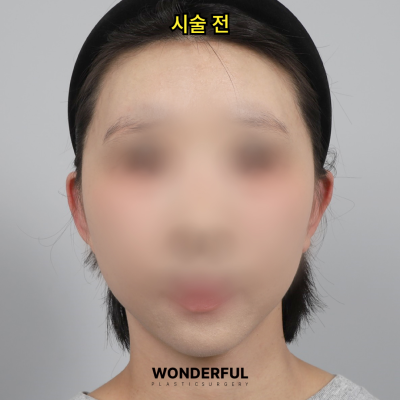 귀필러 효과 총정리! 중안부,광대,비대칭 비교