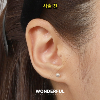 귀필러 효과 총정리! 중안부,광대,비대칭 비교 사진 14