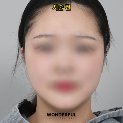 귀필러 효과 총정리! 중안부,광대,비대칭 비교 사진 4