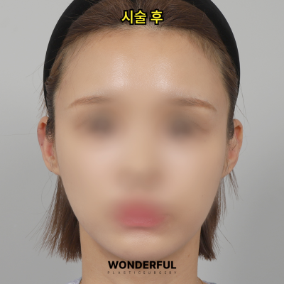 귀필러 효과 총정리! 중안부,광대,비대칭 비교 사진 9
