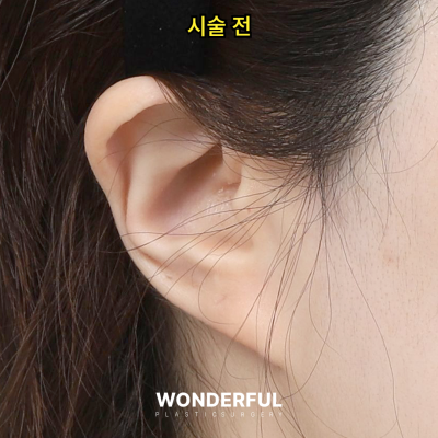 귀필러 효과 총정리! 중안부,광대,비대칭 비교 사진 12