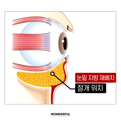 눈밑지와 하안검 차이점 총정리! 효과, 흉터,나이 사진 4