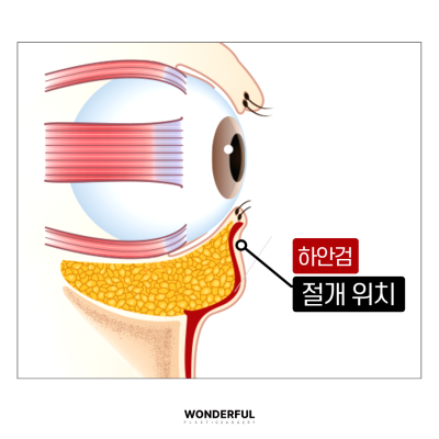 눈밑지와 하안검 차이점 총정리! 효과, 흉터,나이 사진 5