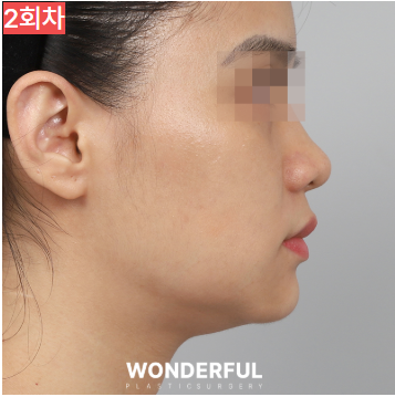 가을에 살이 더 잘빠지는 이유 3가지, 이중턱 빼는 팁 공유! 사진 12