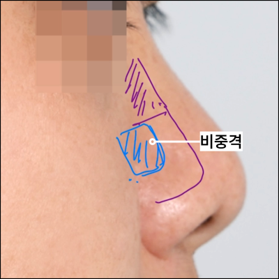 들창코,짧은코,복코,메부리 수술법 *꼭 확인하세요* 사진 5