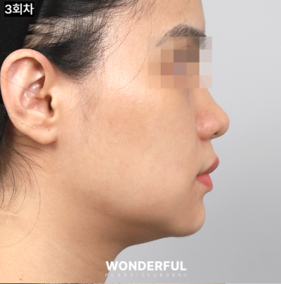 예비신부를 위한 피부시술 3가지 추천! 사진 5