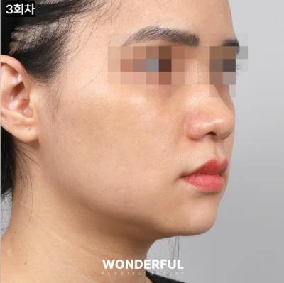 예비신부를 위한 피부시술 3가지 추천! 사진 7