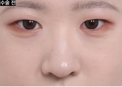 라식 먼저? 쌍꺼풀 수술 먼저? 사진 9