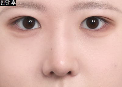 라식 먼저? 쌍꺼풀 수술 먼저? 사진 10