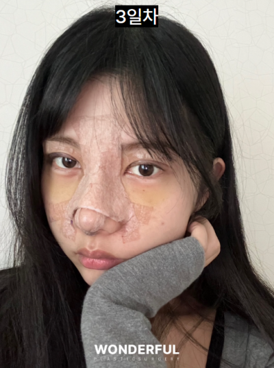 일본인이 한국에서 성형한 이유/눈,무보형물 코 후기 사진 6