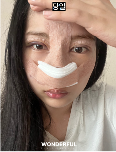 일본인이 한국에서 성형한 이유/눈,무보형물 코 후기 사진 5