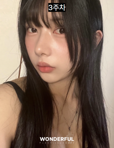 일본인이 한국에서 성형한 이유/눈,무보형물 코 후기 사진 9