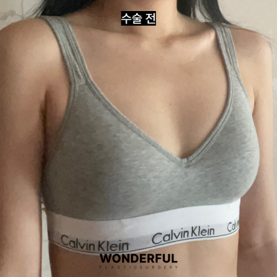 가슴성형/ 밑절, 겨절 장단점 정리 사진 5