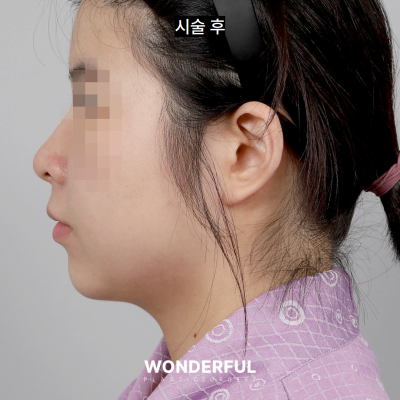 수술 없이 얼굴 윤곽 살리기/ 이중턱 전후 비교 사진 10