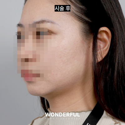 수술 없이 얼굴 윤곽 살리기/ 이중턱 전후 비교 사진 8