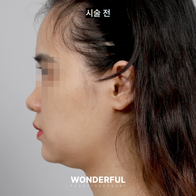 수술 없이 얼굴 윤곽 살리기/ 이중턱 전후 비교 사진 5