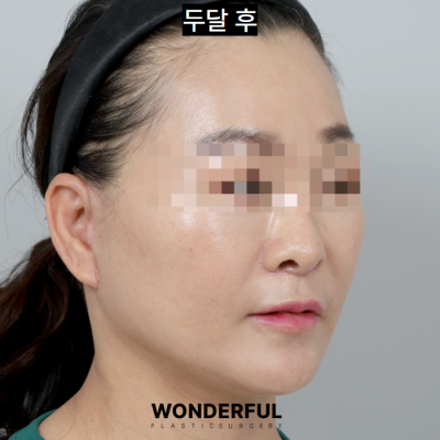 중년 동안 수술 추천, 인중 축소! 효과, 전후 후기 사진 4